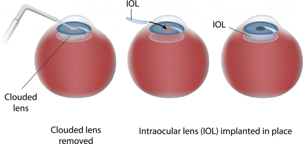 customizable intraocular lens